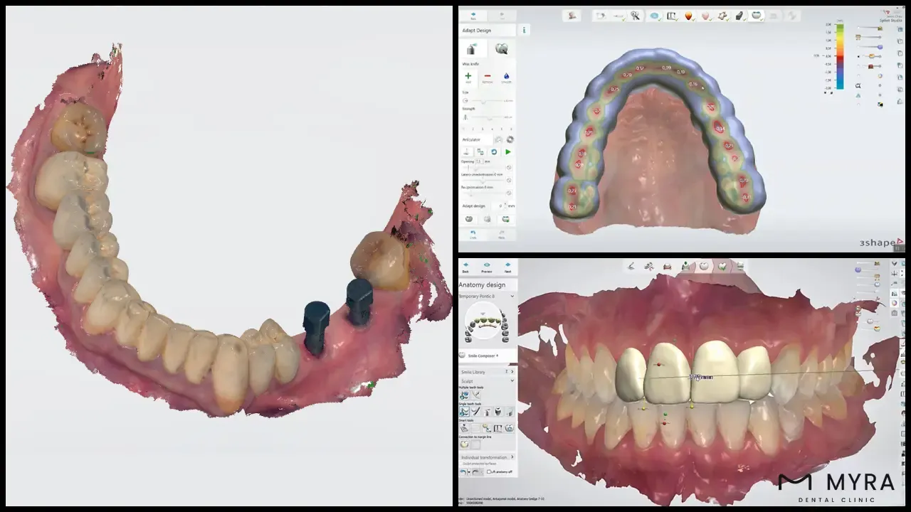 What are the Dental Assessments Before an Immediate Load Implant_.webp